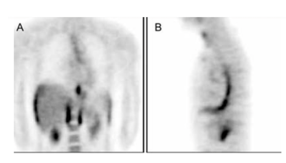 Imágenes de PET de esofagitis