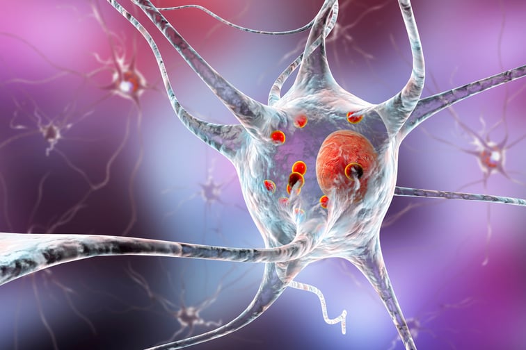 La enfermedad de Parkinson es un síndrome multisistémico