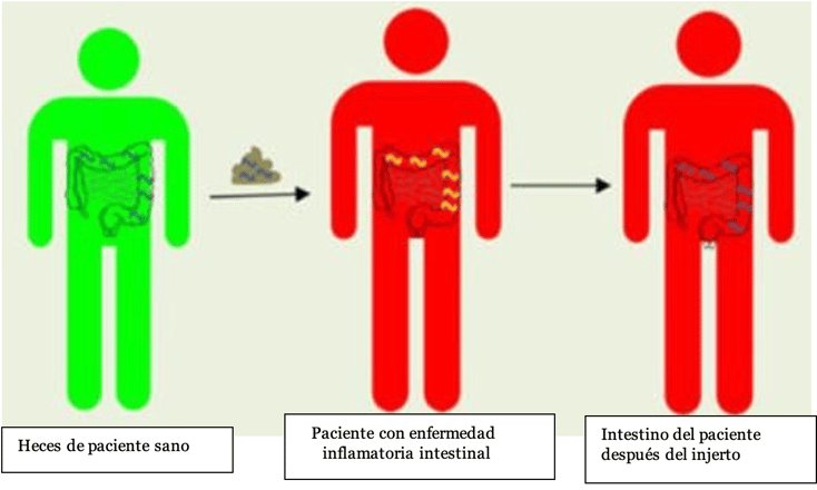 Trasplante de microbiota fecal (TMF)