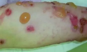 Infección- Penfigoide bulloso o ampolloso